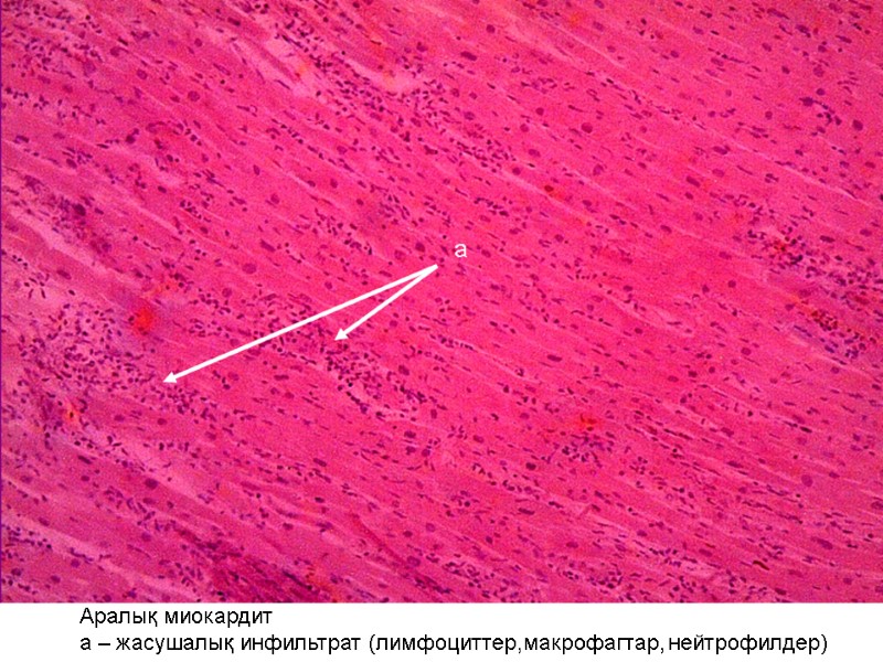 Аралық миокардит а – жасушалық инфильтрат (лимфоциттер,макрофагтар, нейтрофилдер)